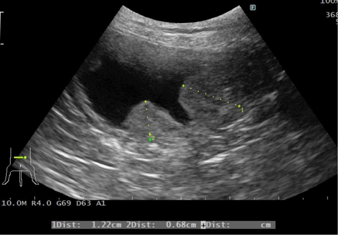 移行上皮がんはどのように診断されますか?